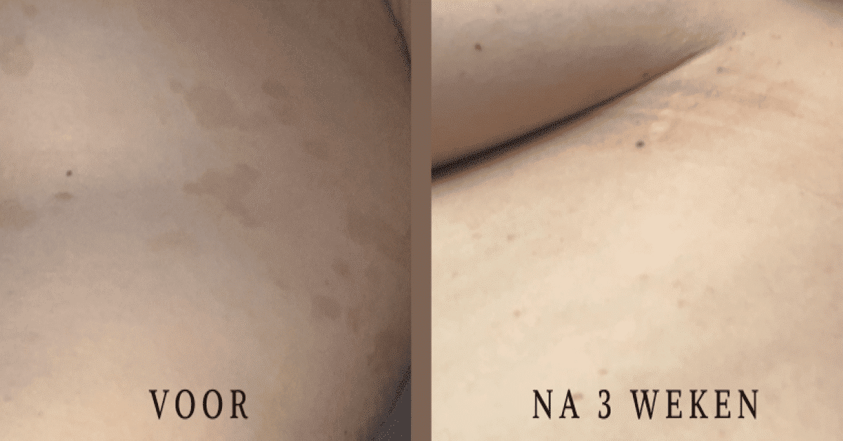 huid infectie www.candidacoach.nl